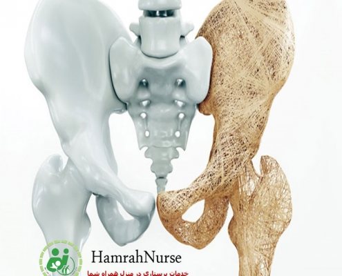 پوکی استخوان در سالمندان