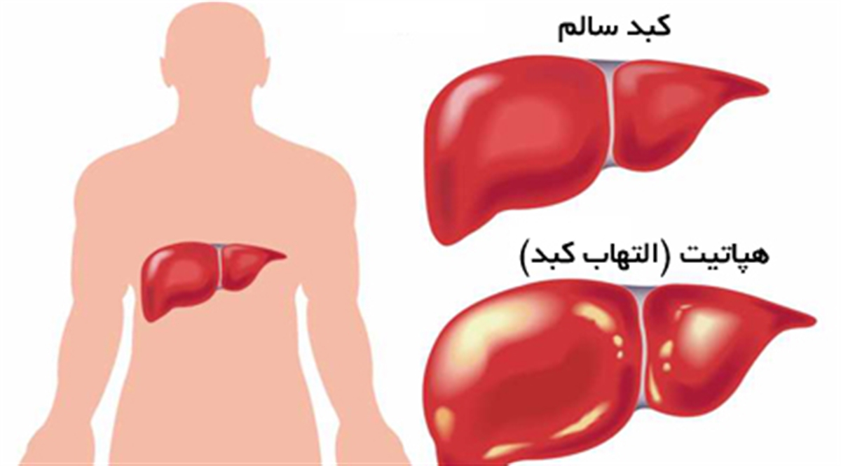 هپاتیت و راه های درمان آن