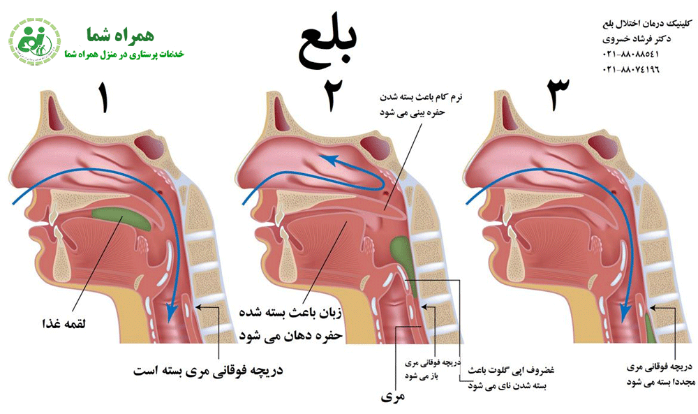 اختلال بلع: مشکلی شایع اما قابل درمان