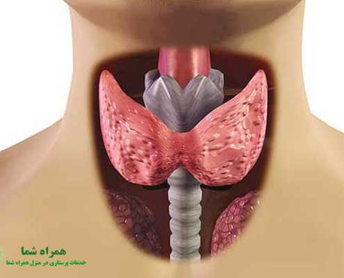 سرطان تیروئید