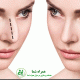 عوارض جراحی بینی