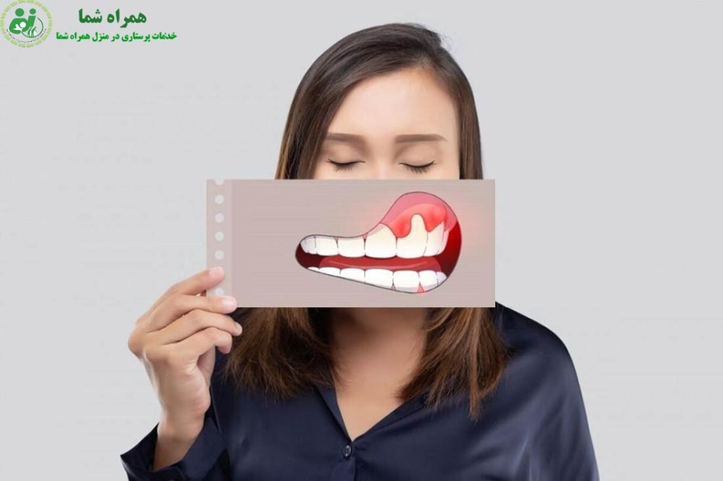 درمان التهاب لثه