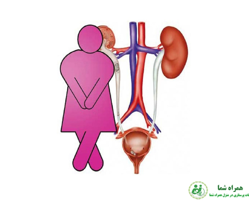 بی اختیاری ادراری در خانم ها