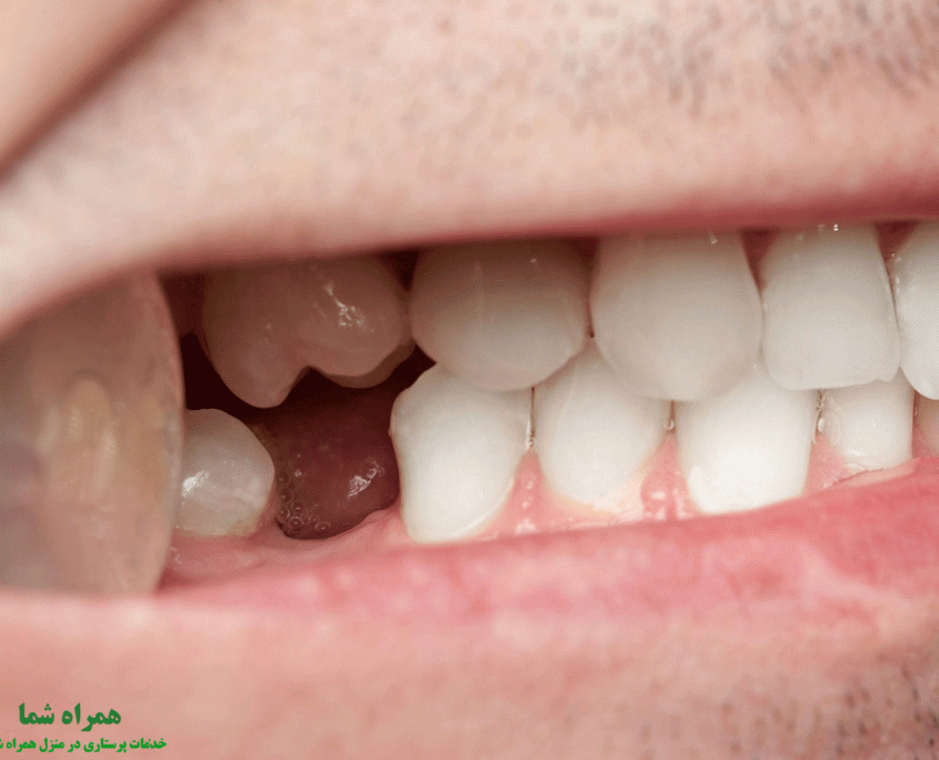 عوارض فضای خالی بین دندان ها