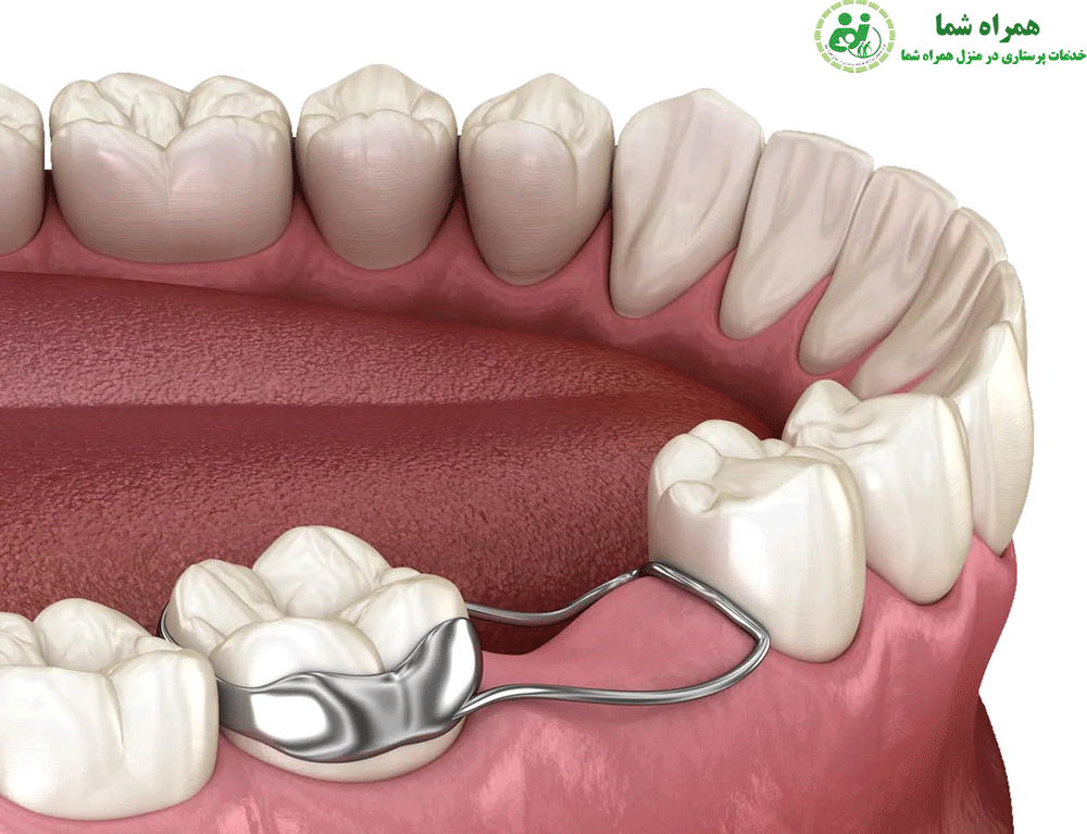 عوارض فضای خالی بین دندان ها