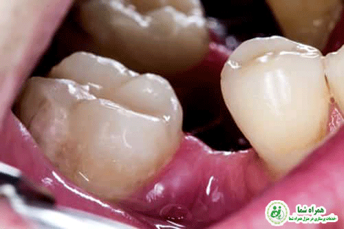 عوارض فضای خالی بین دندان ها