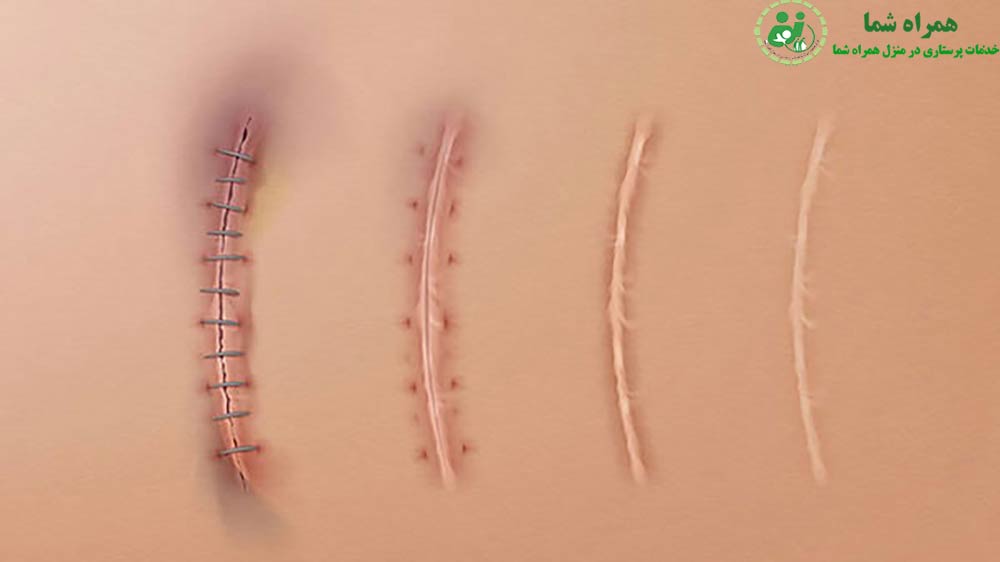 تفاوت بخیه جذبی و غیرجذبی