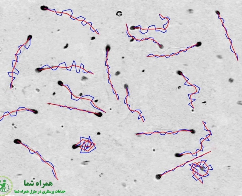 نشانه های آزواسپرمی