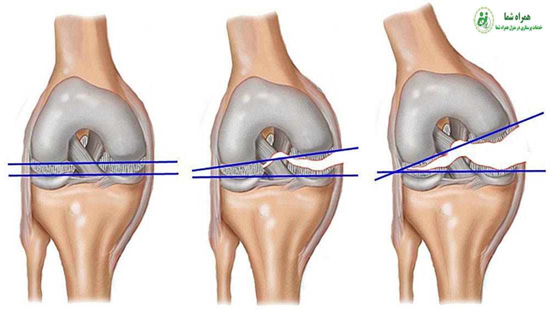 پارگی رباط صلیبی زانو